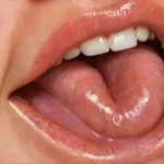 Primer plano de una lengua hinchada y roja con detalles de inflamación y un piercing